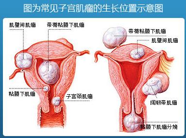 子宫肌瘤