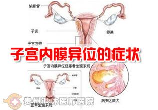 子宫内膜异位证