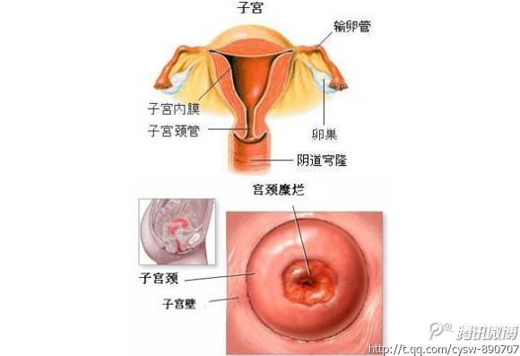 宫颈糜烂