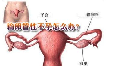 输卵管性不孕