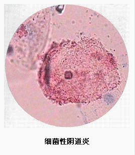 细菌性阴道炎