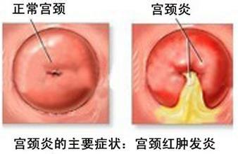 宫颈炎对比图