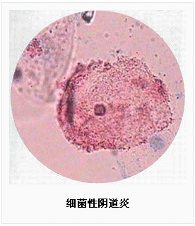 细菌性阴道炎