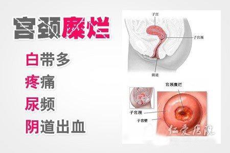 宫颈糜烂