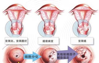 宫颈炎病变图