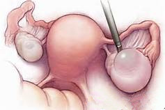 卵巢囊肿所导致的具体危害主要表现